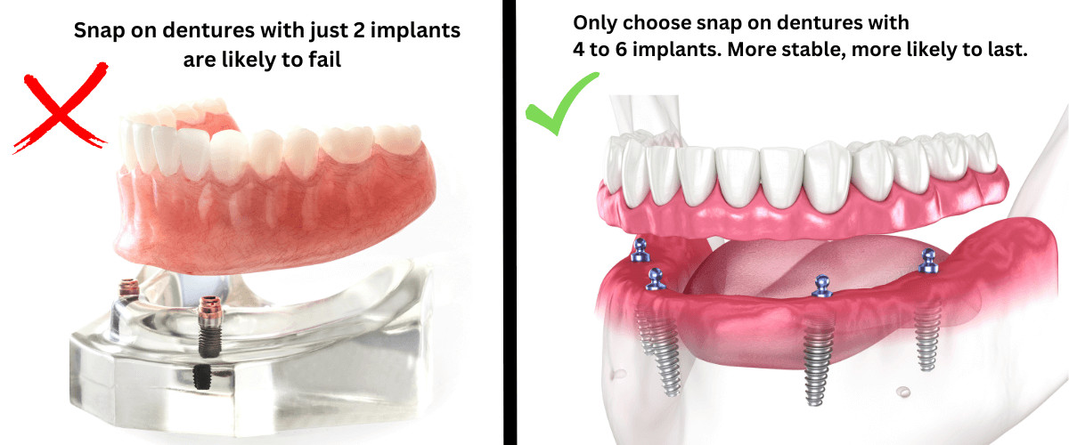 snap on dentures