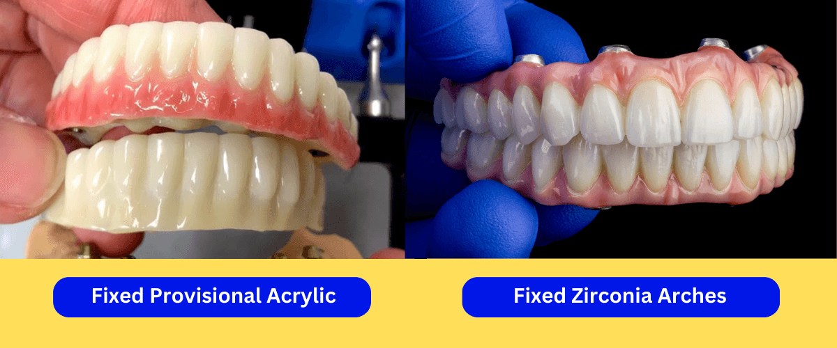 provisional vs fixed zirconia