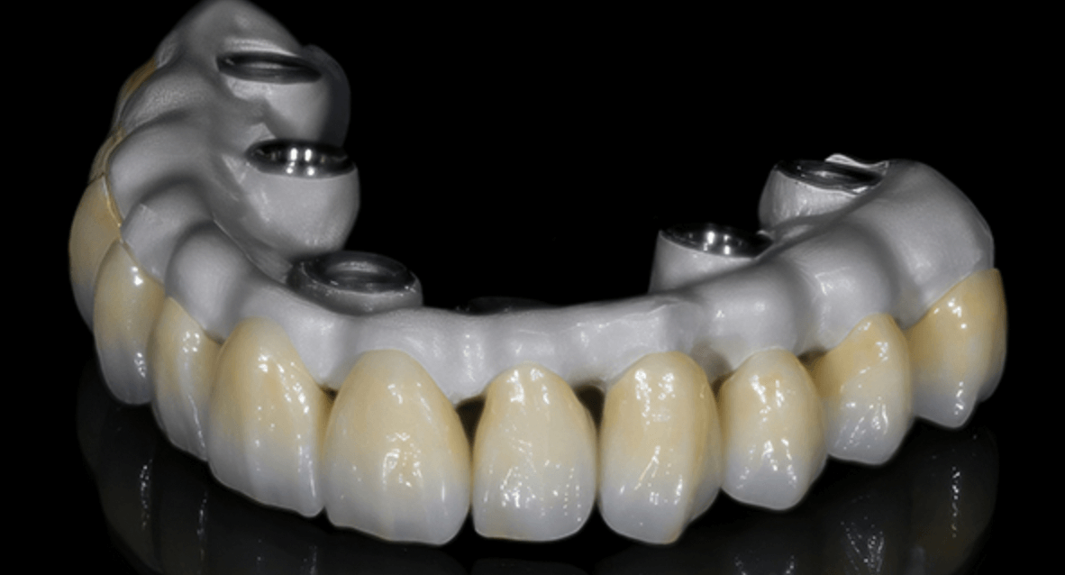 dental implants