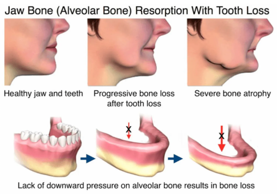 jaw bone resorption with tooth loss