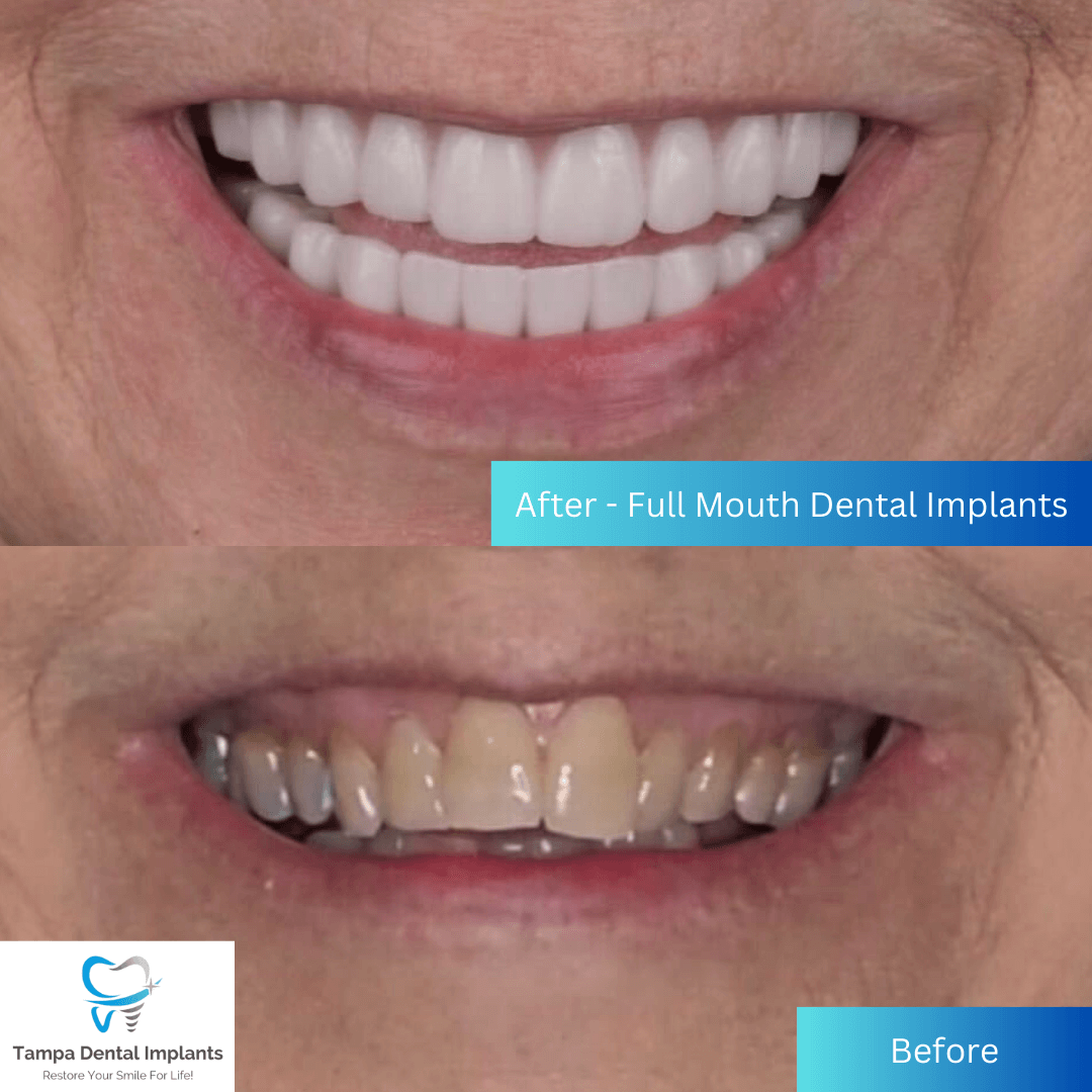 before and after full mouth dental implants