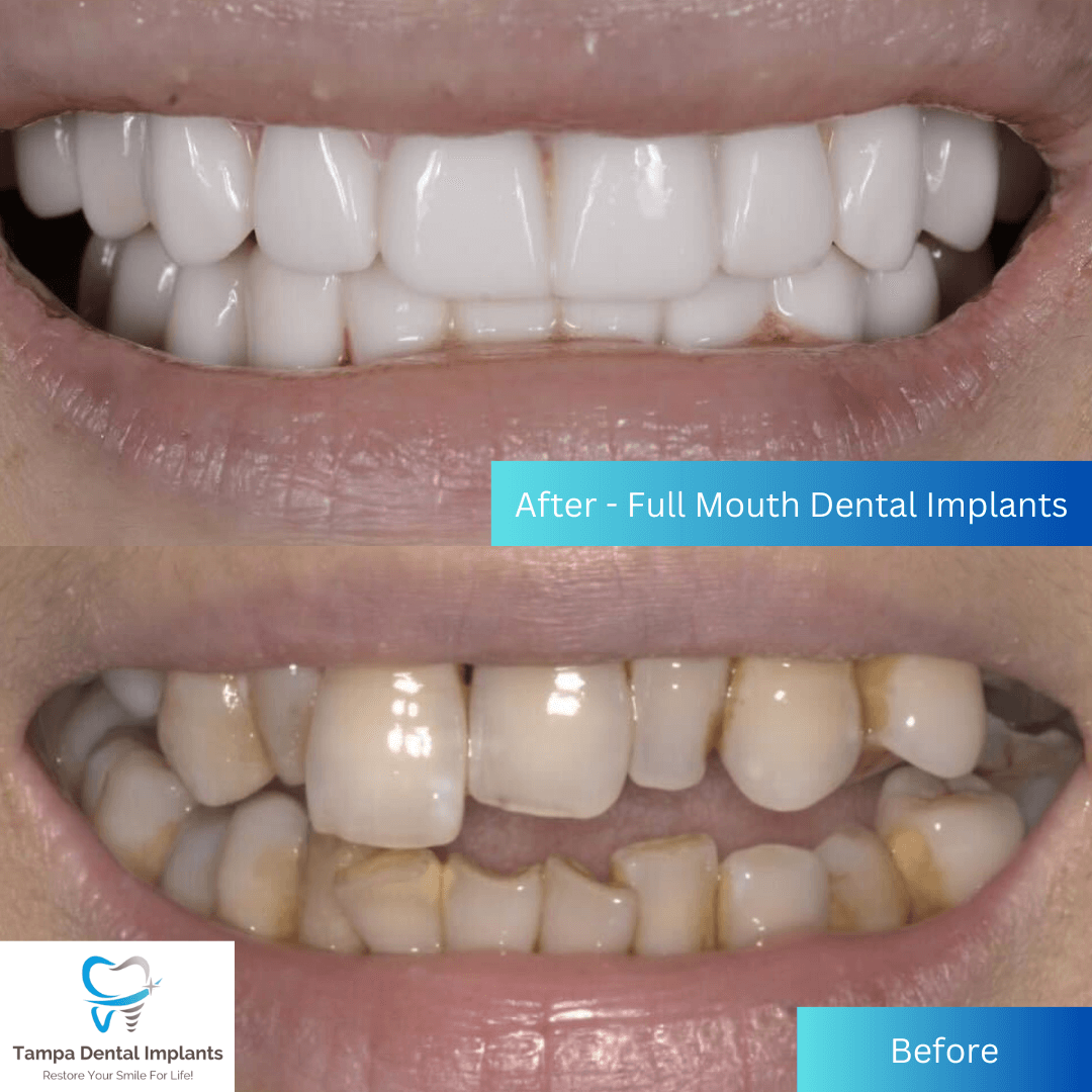 before and after full mouth dental implants