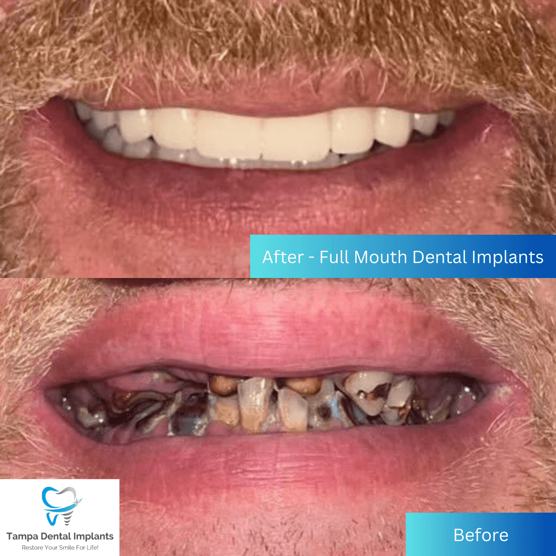 before and after full mouth dental implants