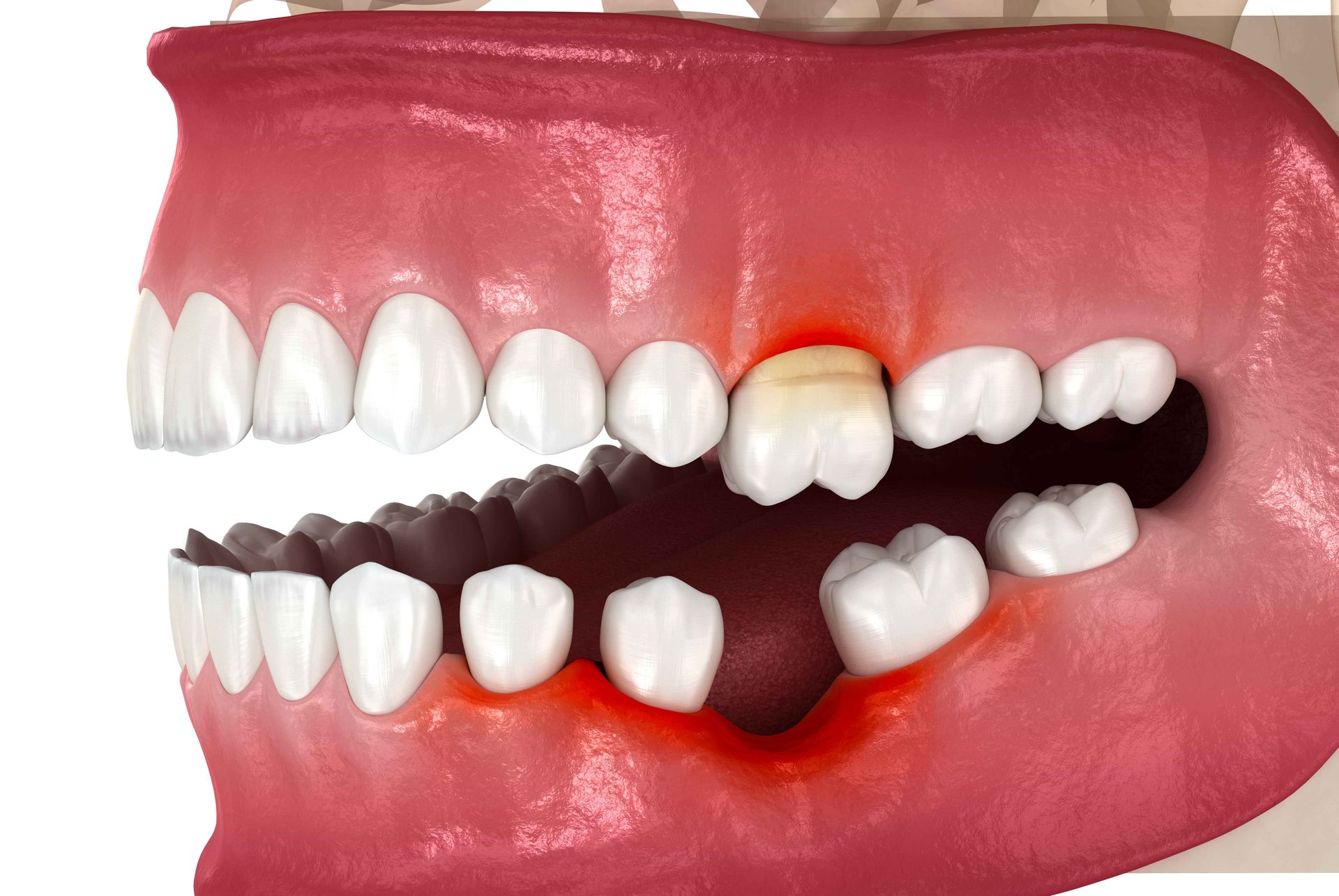dental implant failure treatment