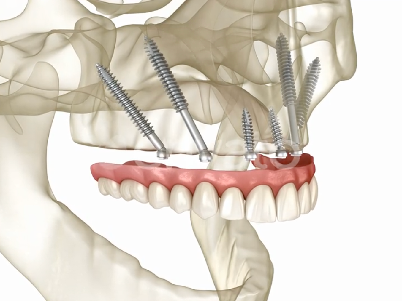 zygomatic dental implants