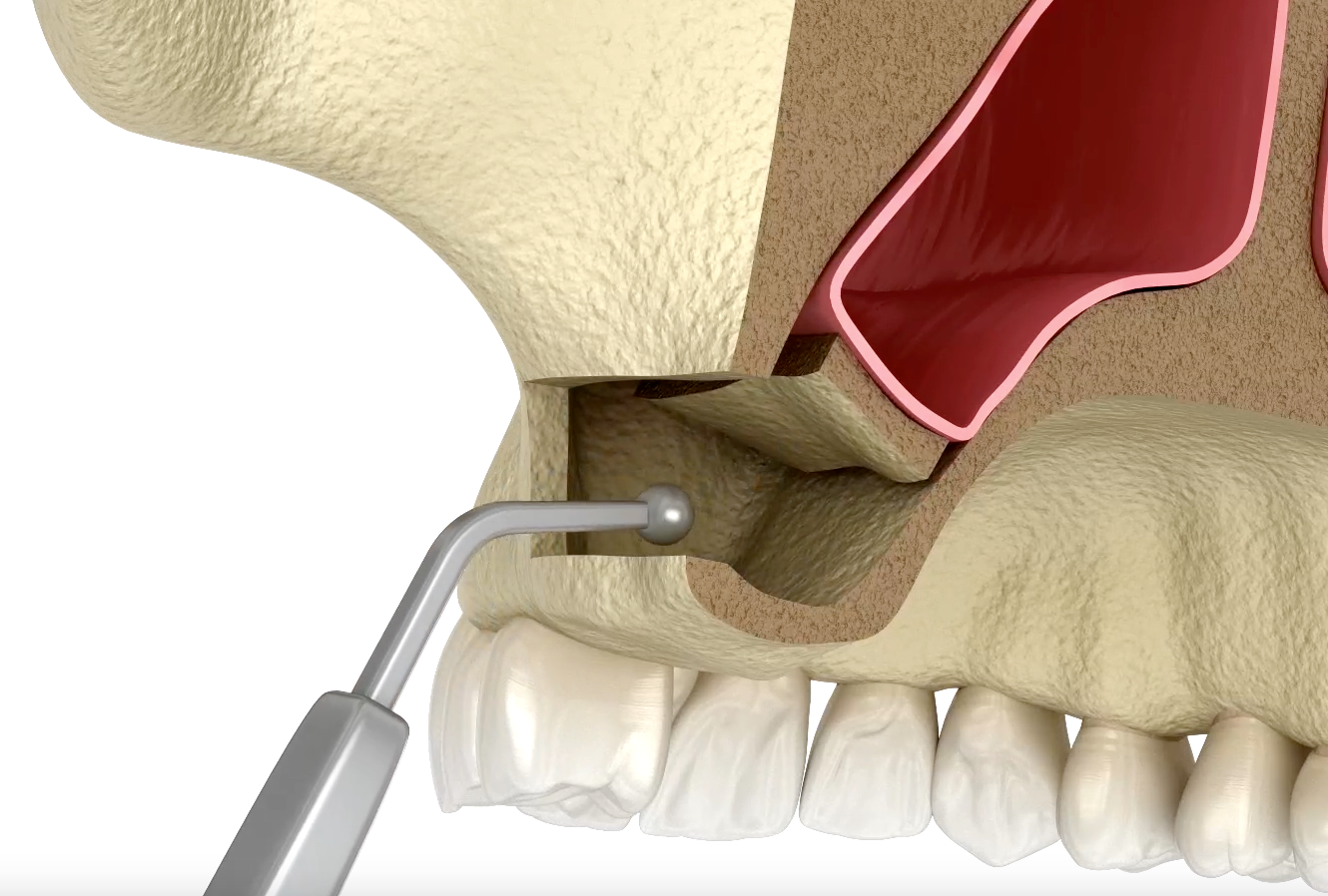 sinus lift surgery