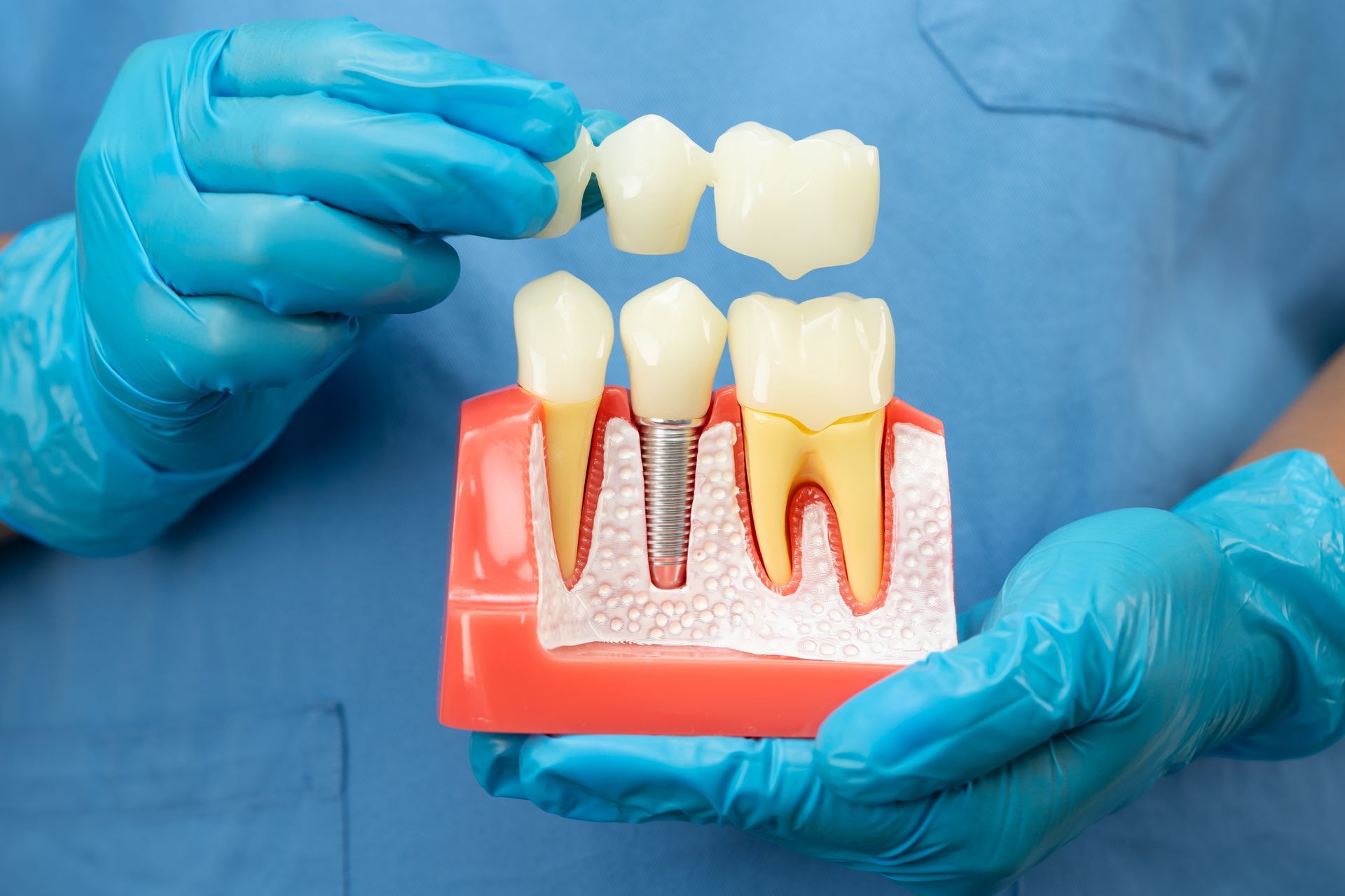 Gloved hands holding a dental implant model and crown pieces on a blue background