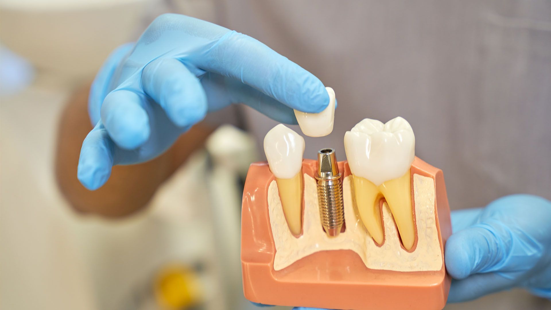 A dental model showing a tooth implant process, with a hand wearing a blue glove holding a crown.