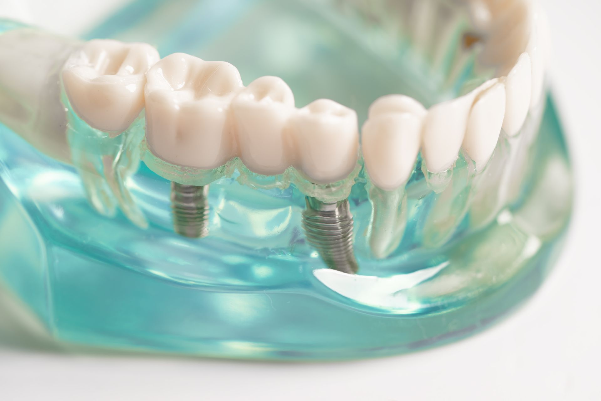 Dental implant model with artificial teeth and two metal implants in a clear blue gum base