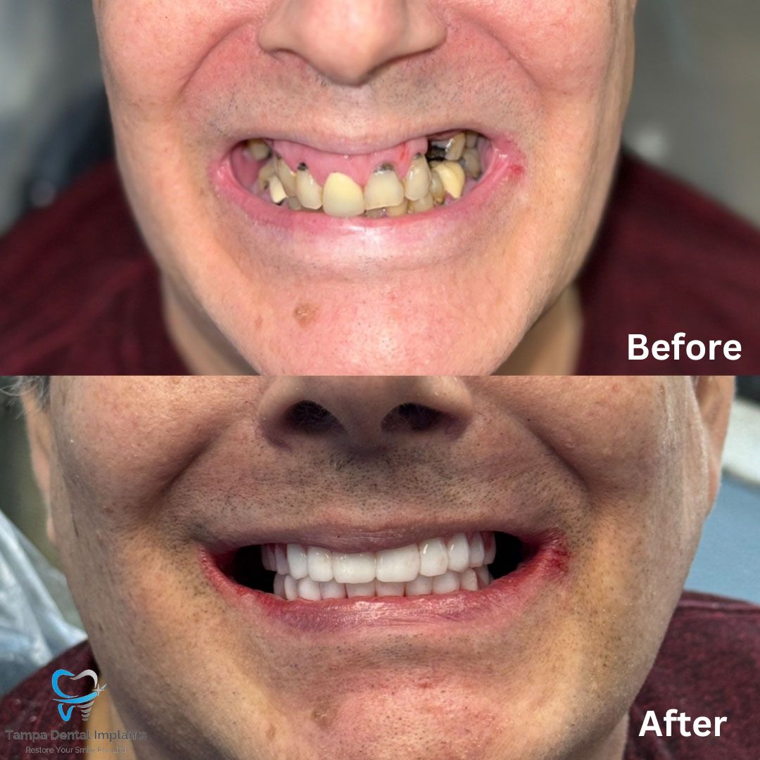Dental Implants