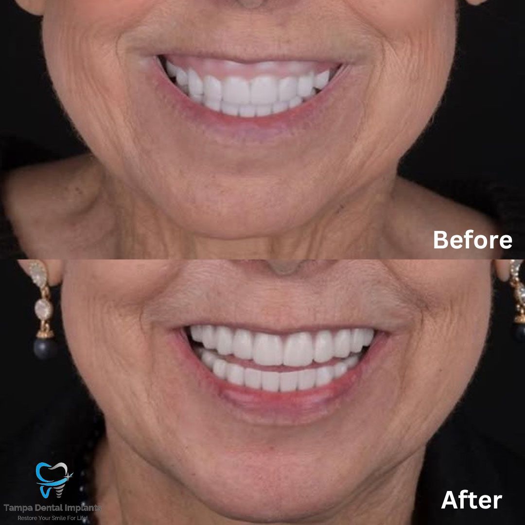 Dental Implants