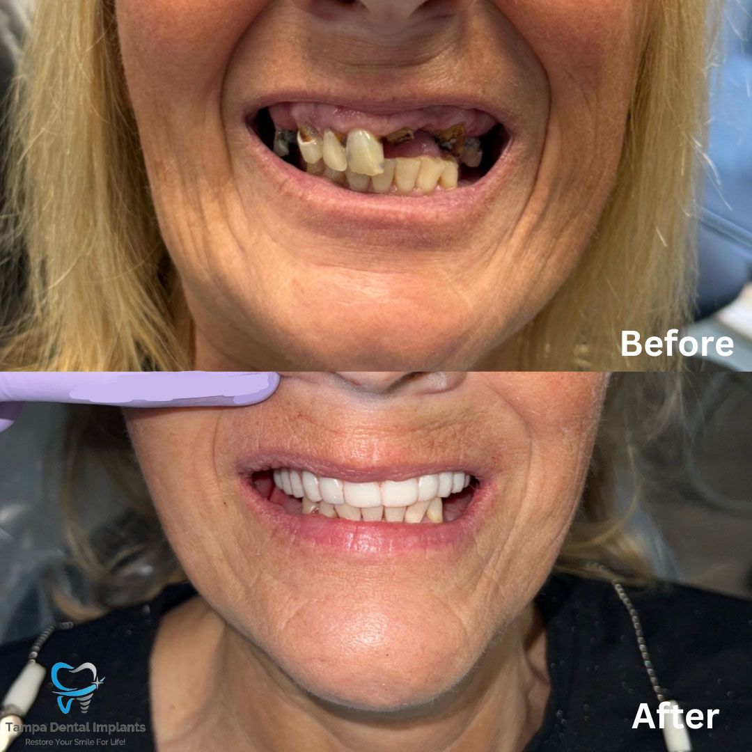 Dental Implants