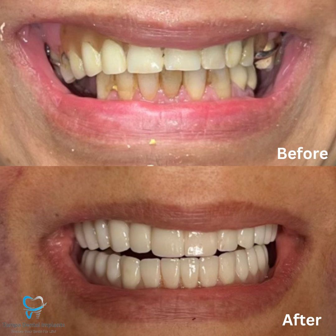 Dental Implants