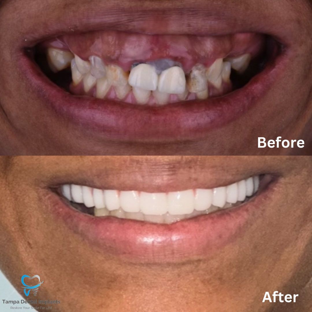 Dental Implants