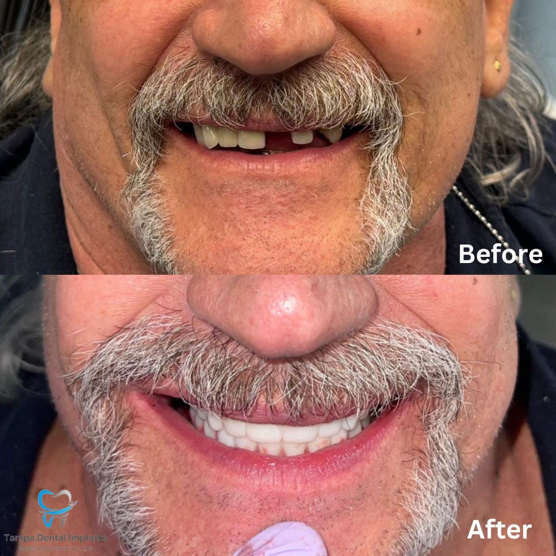 Dental Implants