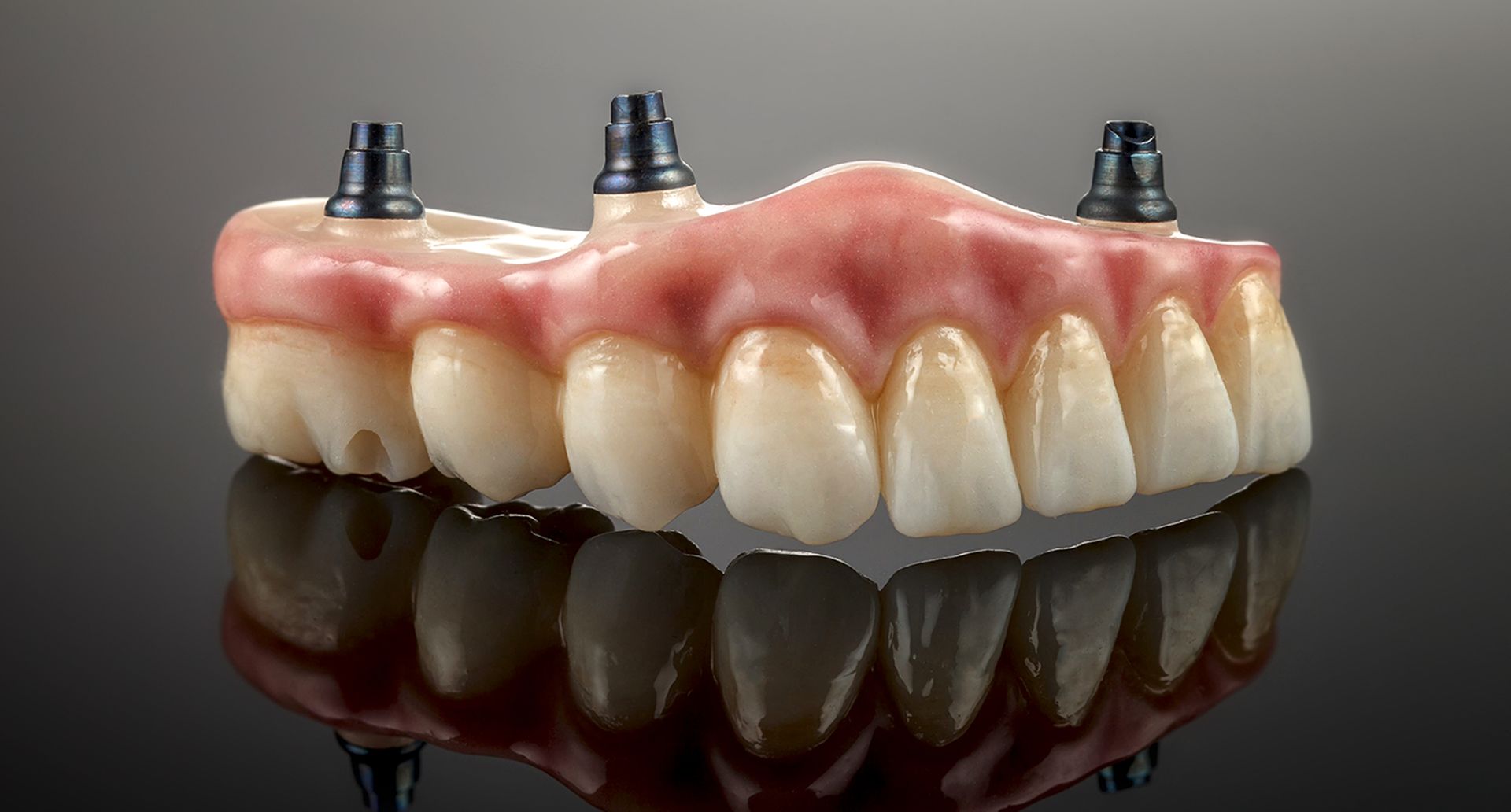 Dental model of upper teeth with three implants.