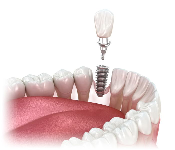 single tooth dental implant