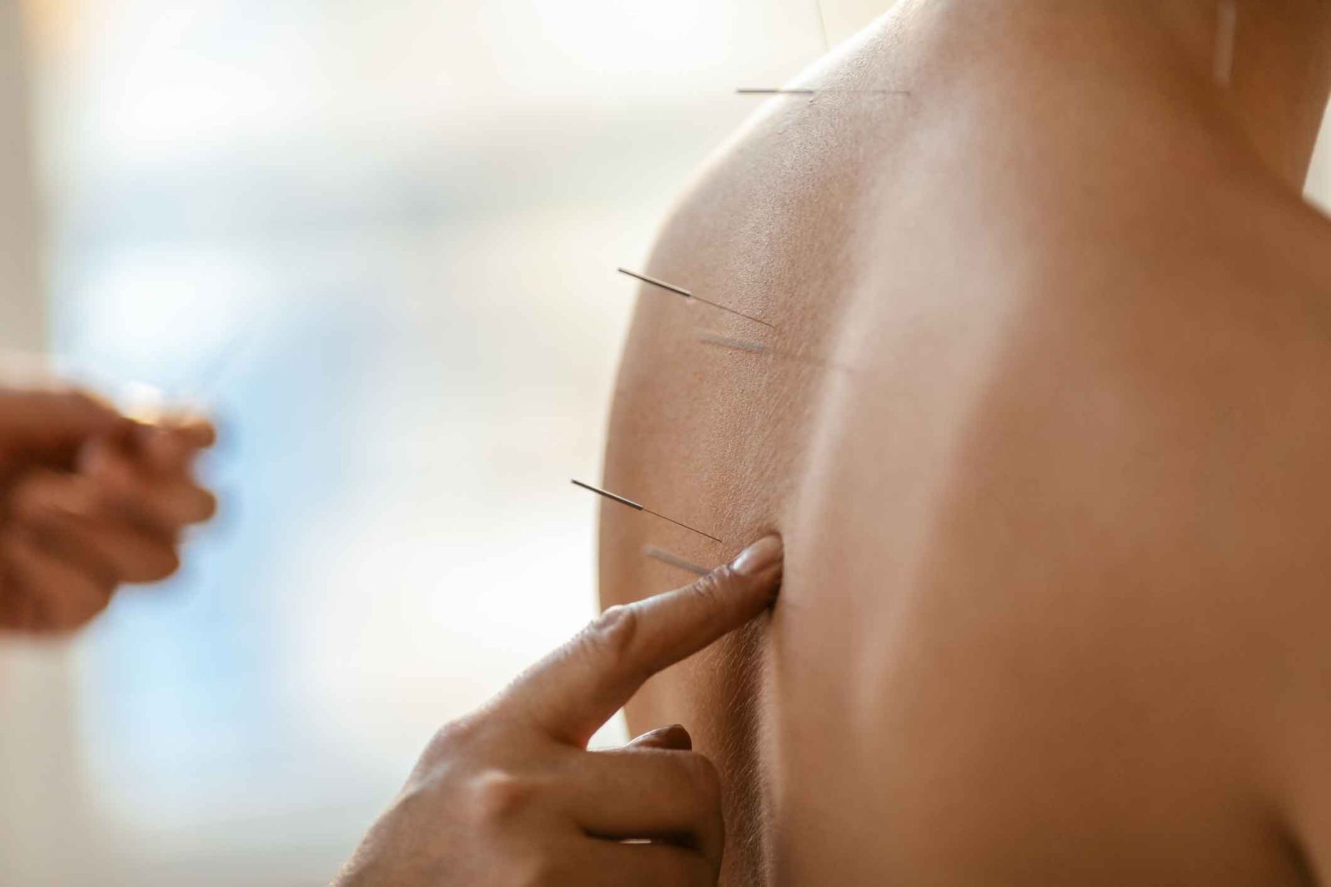 Acupuncture on person's back.