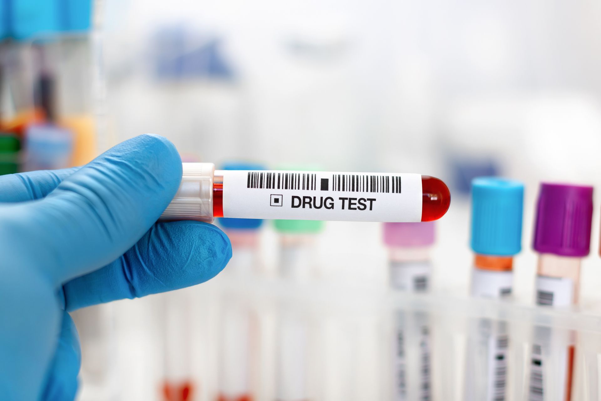Doctor's hand holding urine and blood samples for instant drug screening at Salisbury Medical Centre laboratory in Brisbane.