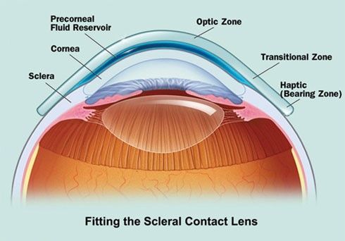 כאן ניתן לראות את הנוזלים שמכסות את כל הקרנית ואת העדשה שנוגעת רק בלובן של העין.   