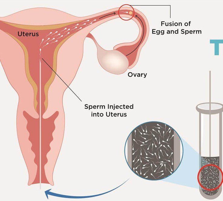 Diagram of a female reproductive system showing sperm injection into the uterus and fertilization of an egg.