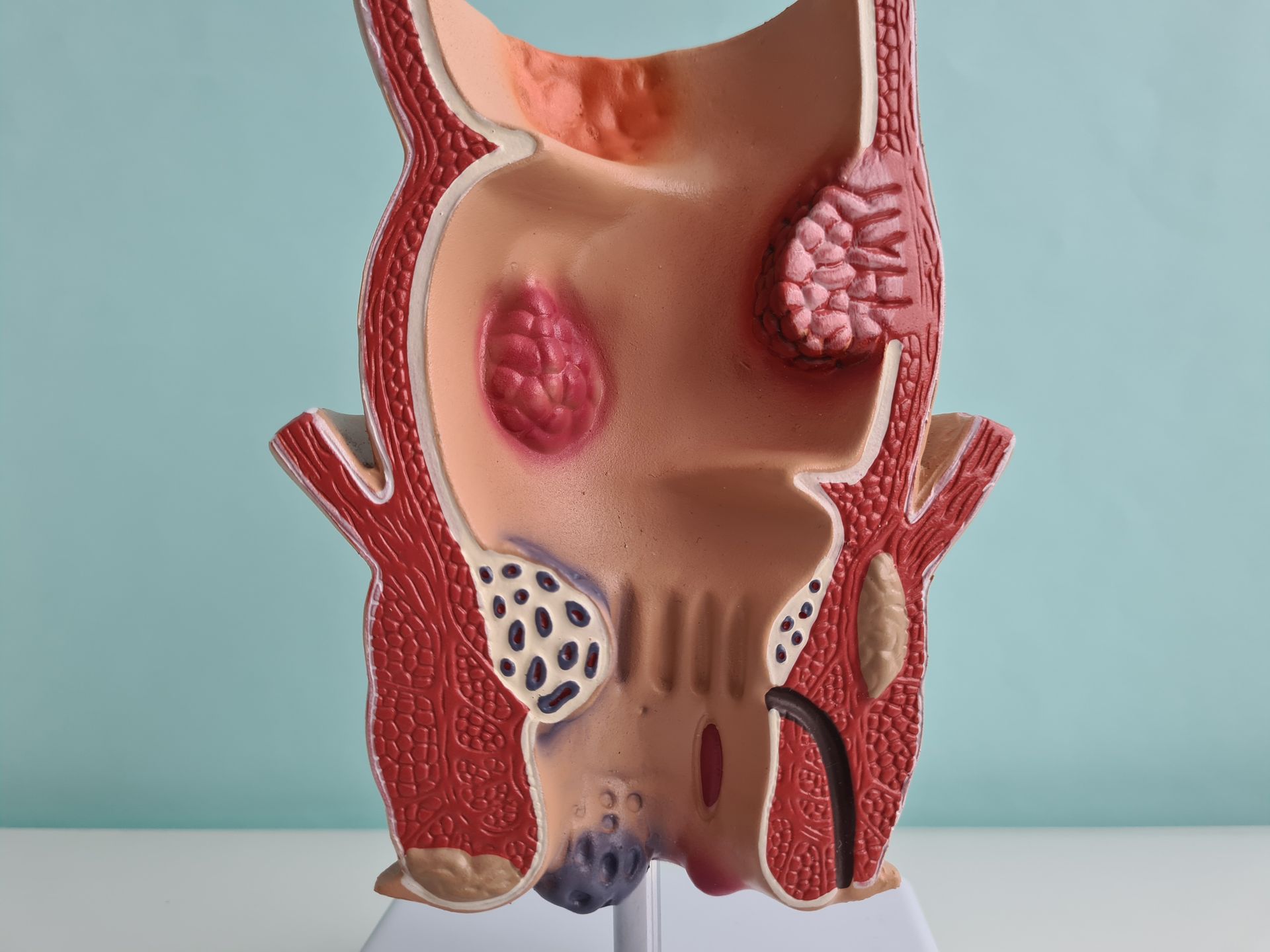 Modell eines Rektums mit sichtbaren Hämorrhoiden in Rot und Braun, Querschnitt.