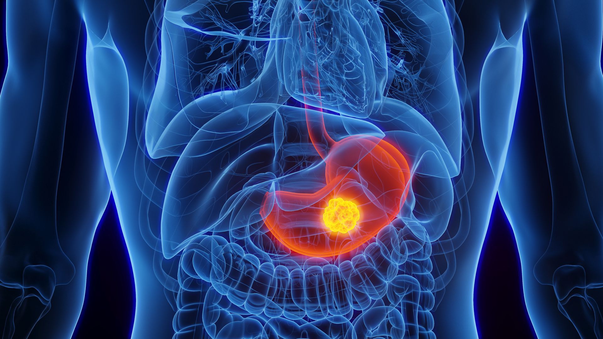 Ein computergeneriertes Bild des Magens einer Person mit einem Tumor.