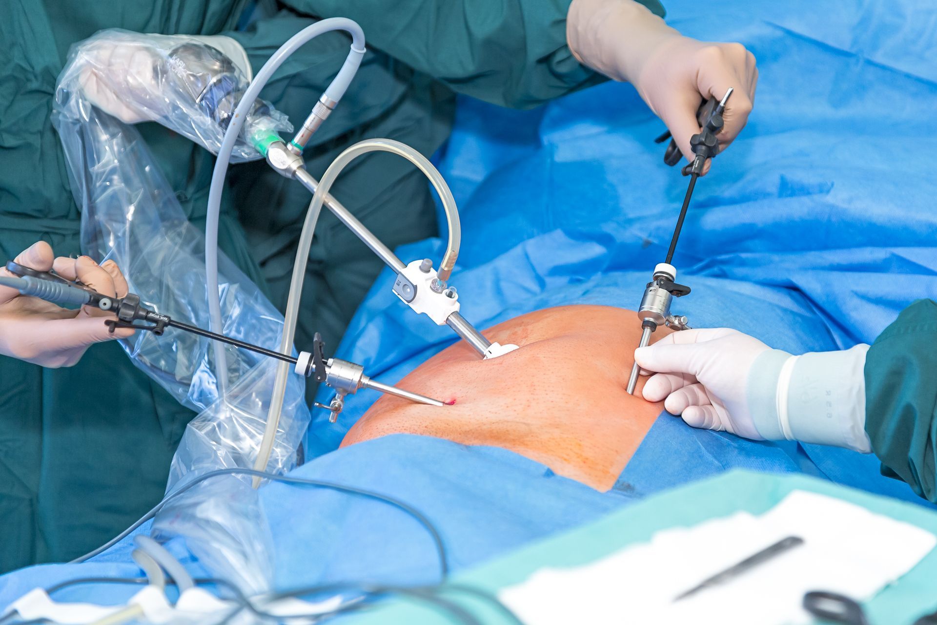 Ein Chirurg führt eine laparoskopische Operation am Magen eines Patienten durch.