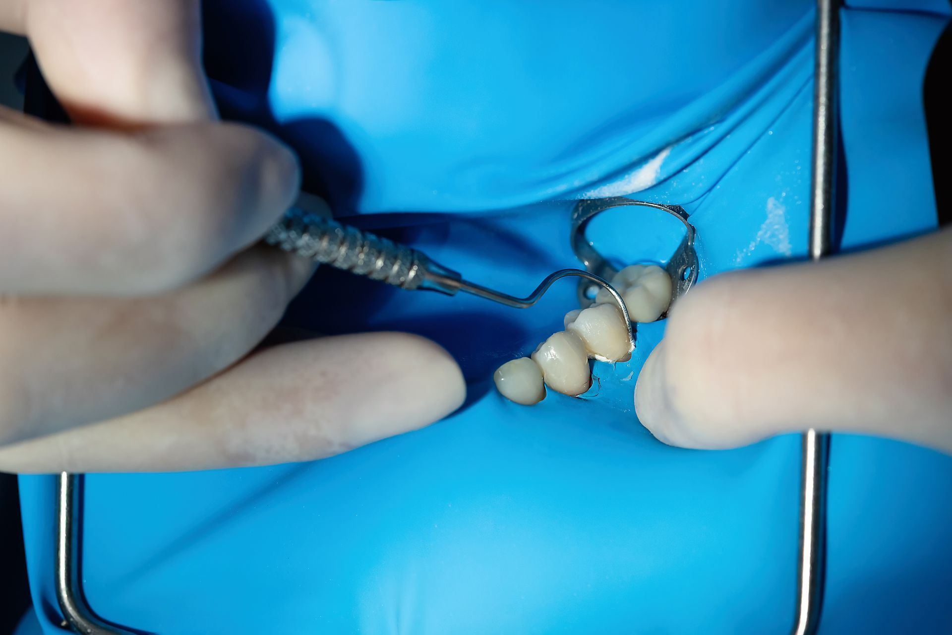 Gloved hands using dental tools on a blue surface with a row of teeth models Gloved hands using dental tools on a blue surface with a row of teeth models