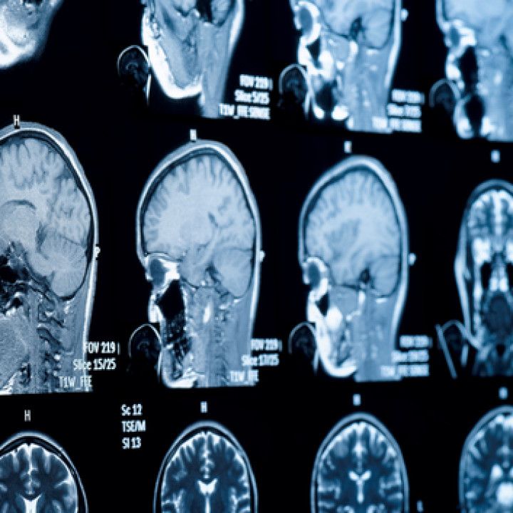 Brain X-Ray Results