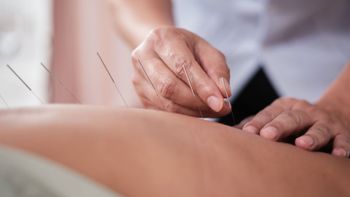 Close-up of hands placing acupuncture needles in a person’s back