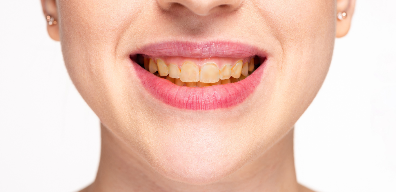 A close up of a woman 's mouth with yellow teeth.