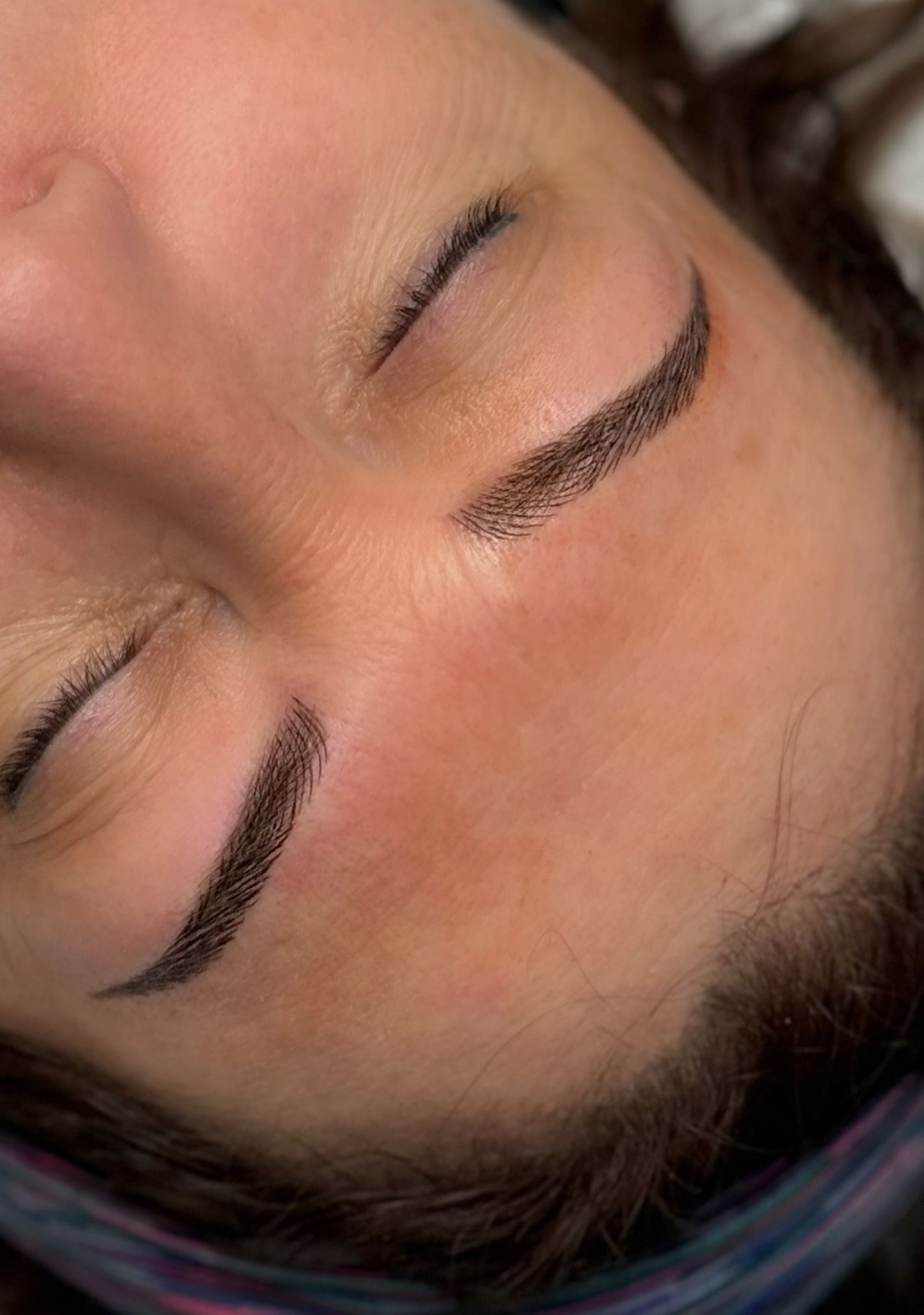 Browlifting