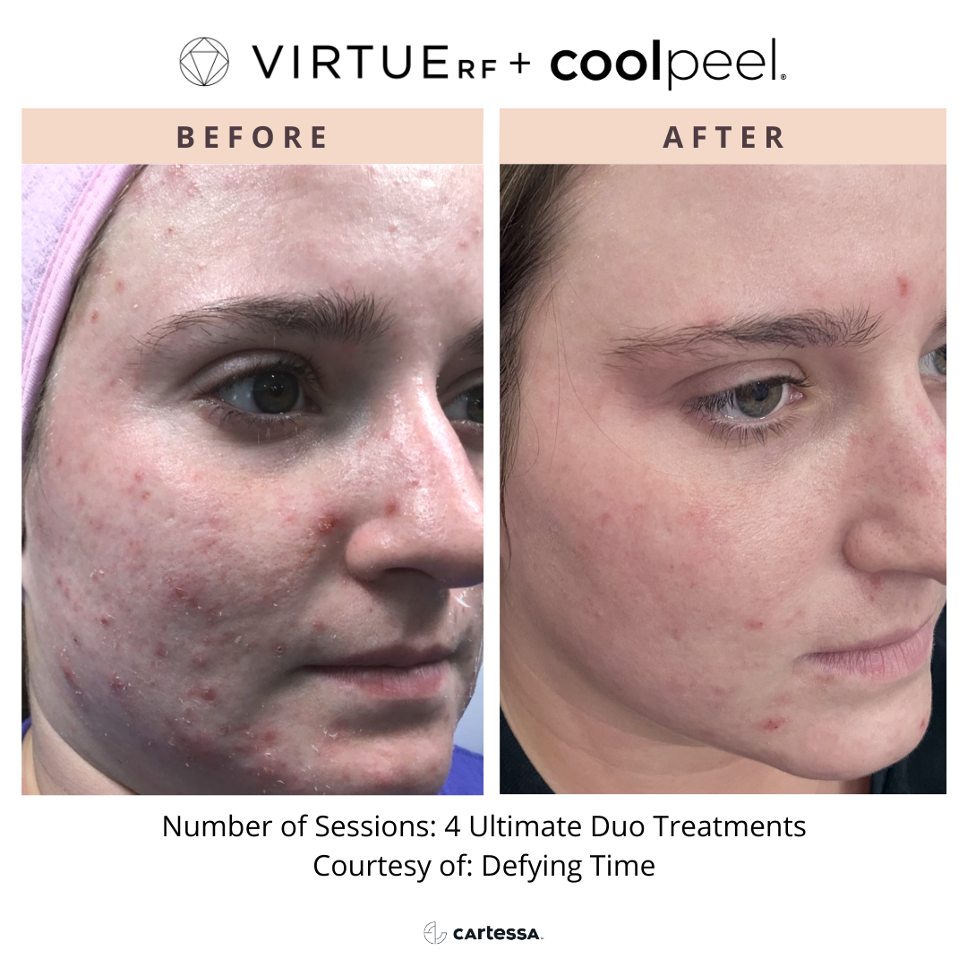 Side-by-side acne treatment comparison: left before, right after, showing clearer skin and reduced blemishes.