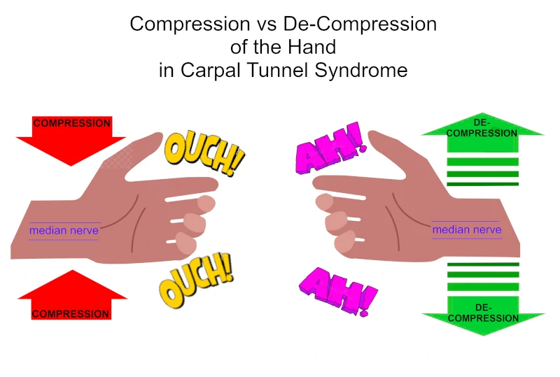 Compression Gloves for Carpal Tunnel Syndrome