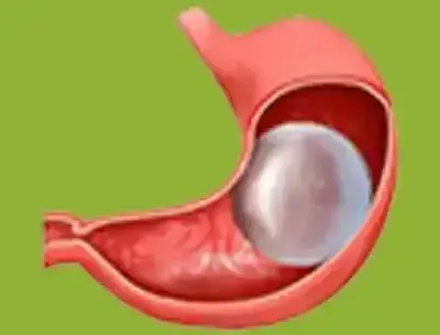 Stomach Balloon