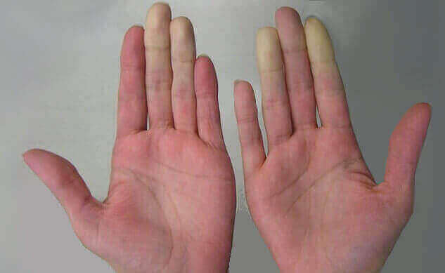 White fingertips resulting from hand arm vibration syndrome.