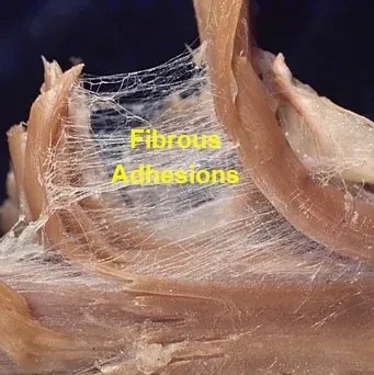 fibrous adhesion in the fascia