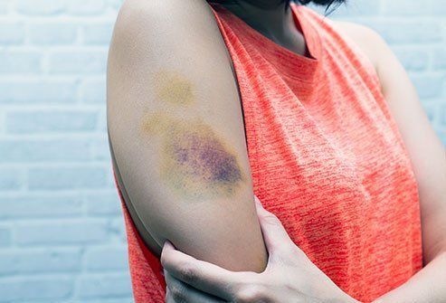 woman's bruised arm
