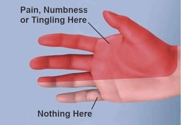 where carpal tunnel symptoms appear