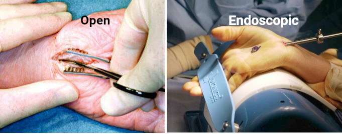 open and endoscopic carpal tunnel surgery