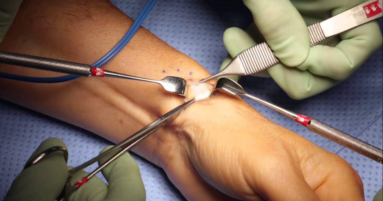 surgery for de Quervain's syndrome