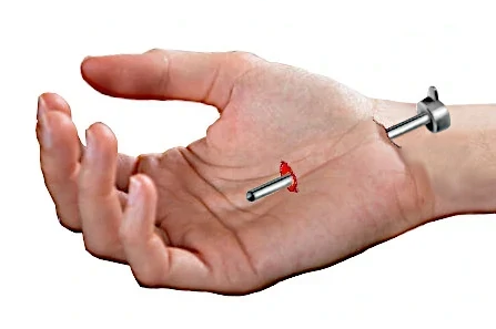 endoscopic carpal tunnel surgery