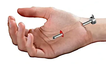 carpal tunnel surgery