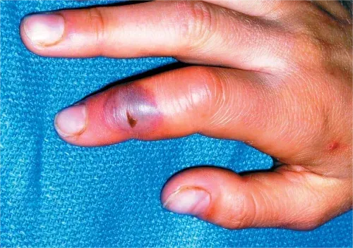 finger infection