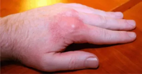 gout in the hand