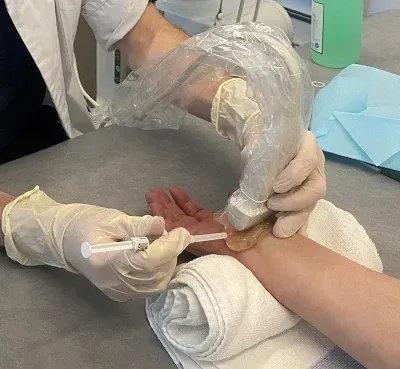 hydrodissection for carpal tunnel syndrome