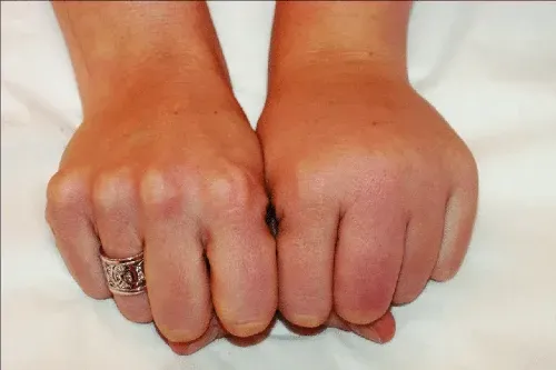 lymphedema in hands