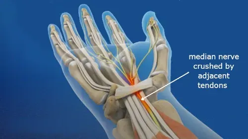 median nerve inside the carpal tunnel