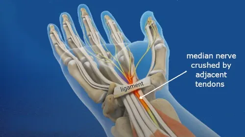 carpal tunnel space